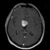 6A2 Craniopharyngioma, Papillary (Case 6)  T1W - Copy