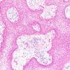 6B2 Craniopharyngioma, Papillary (Case 6)  H&E 10X