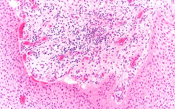 6B4 Craniopharyngioma, Papillary (Case 6)  H&E 20X 2