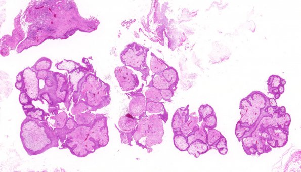 7A1 Craniopharyngioma, papillary (Case 7) H&E WM