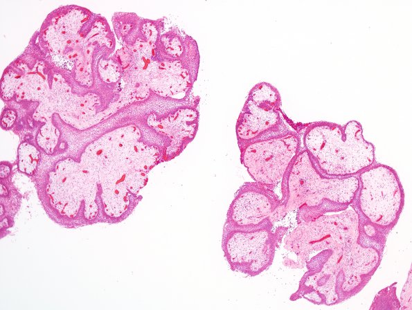 7A2 Craniopharyngioma, papillary (Case 7) H&E 14.jpg