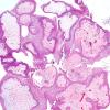 7A3 Craniopharyngioma, papillary (Case 7) H&E 13.jpg