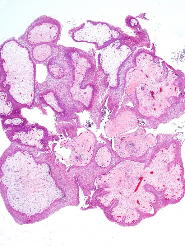 7A3 Craniopharyngioma, papillary (Case 7) H&E 13.jpg