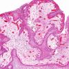 7A4 Craniopharyngioma, papillary (Case 7) H&E 8.jpg