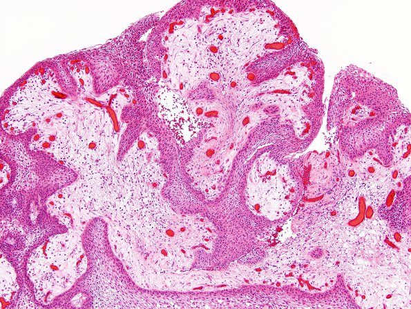 7A4 Craniopharyngioma, papillary (Case 7) H&E 8.jpg