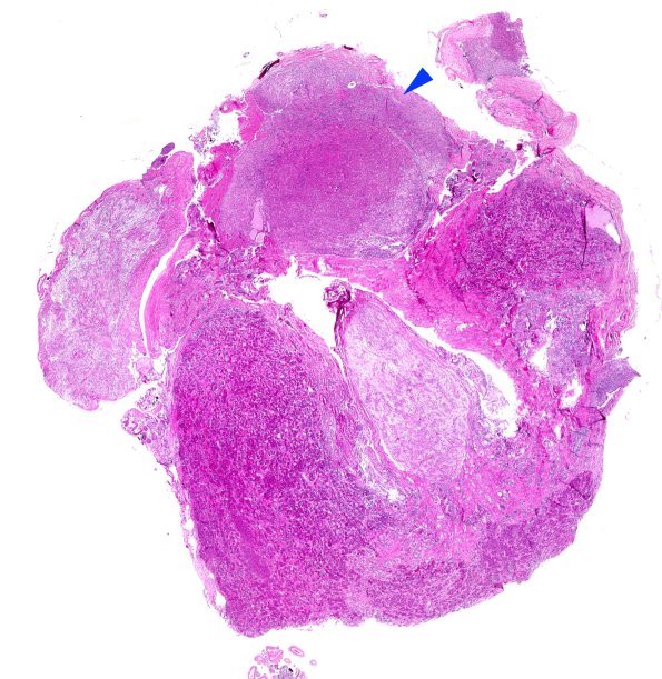 10A1 Granular cell tumor (Case 10) H&E WM copy