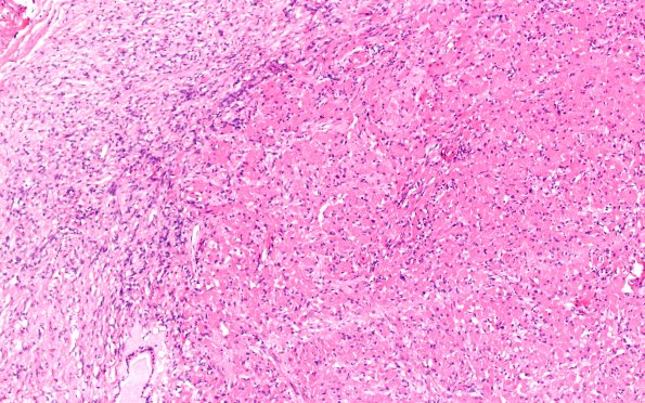 10A2 Granular cell tumorlet (Case 10) H&E 10X