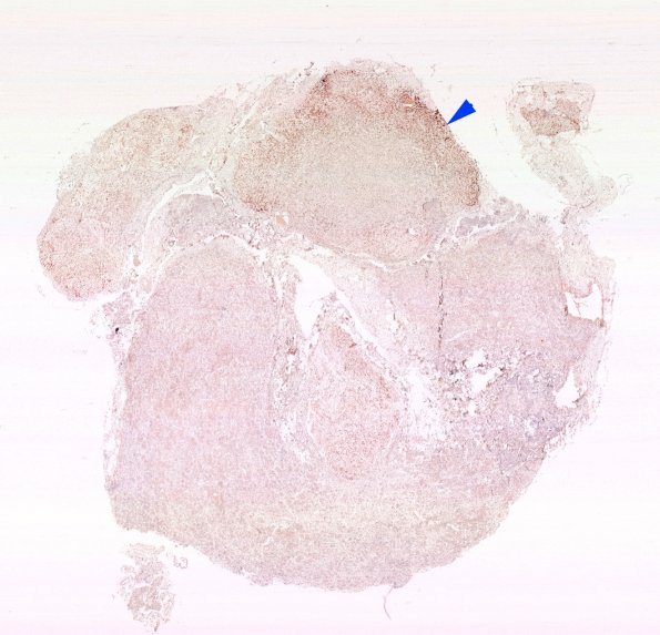 10B1 Granular cell tumor (Case 10) TTF WM copy