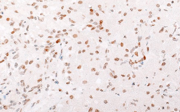 10B2 Granular cell tumor (Case 10) TTF 60X 2