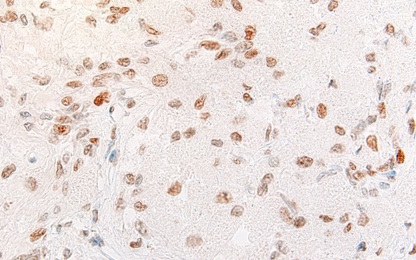 10B3 Granular cell tumor (Case 10) TTF 60X 3