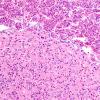 1A3 Granular Cell Tumor (Case 1) H&E 4