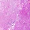 A5 Granular Cell Tumor (Case 1) H&E 15A