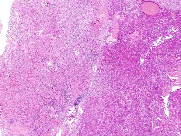 A5 Granular Cell Tumor (Case 1) H&E 15A