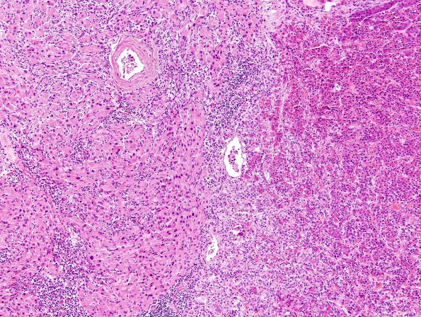 1A6 Granular Cell Tumor (Case 1) H&E 6A