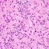 1A8 Granular Cell Tumor (Case 1) H&E 1.