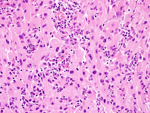 1A8 Granular Cell Tumor (Case 1) H&E 1.