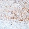 1B2 Granular Cell Tumor (Case 1) VIM 3A