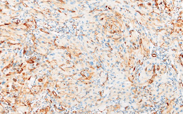 1B3 Granular Cell Tumor (Case 1) VIM 4 20X