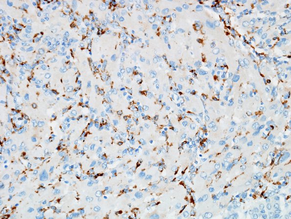 1C3 Granular Cell Tumor (Case 1) CD68 3