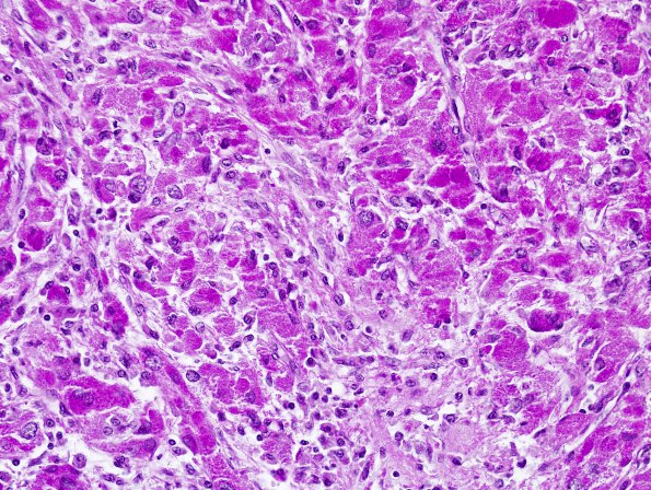 1E3 Granular Cell Tumor (Case 1) PAS 1