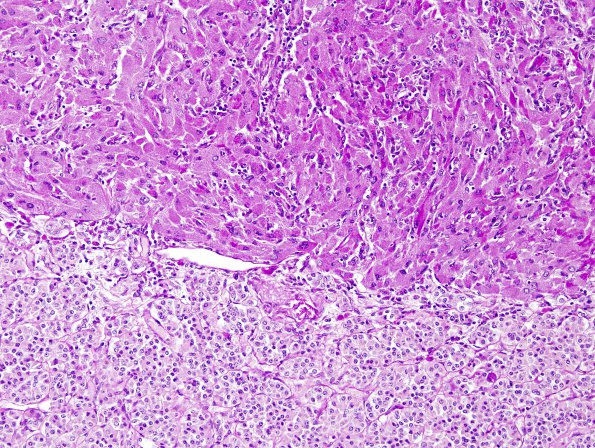 1F2 Granular Cell Tumor (Case 1) PAS-D 1