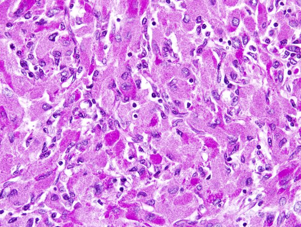 1F3 Granular Cell Tumor (Case 1) PAS-D 5