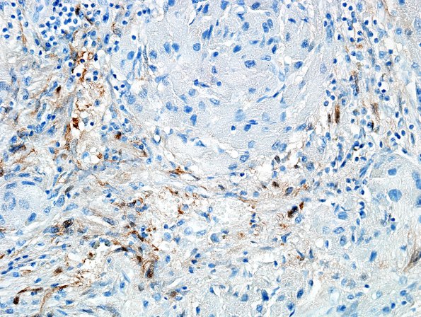 1G2 Granular Cell Tumor (Case 1) S100 2A