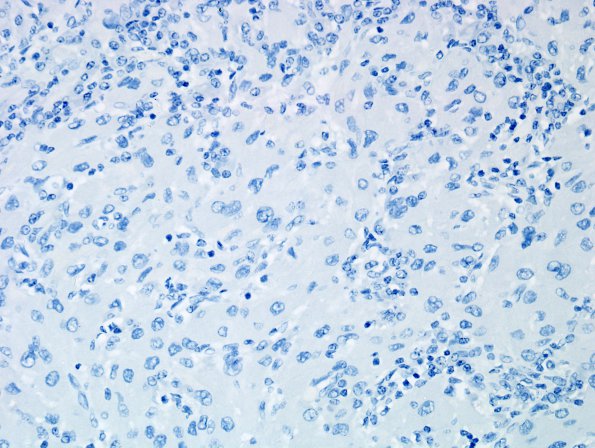 1H5 Granular Cell Tumor (Case 1) SYN 1