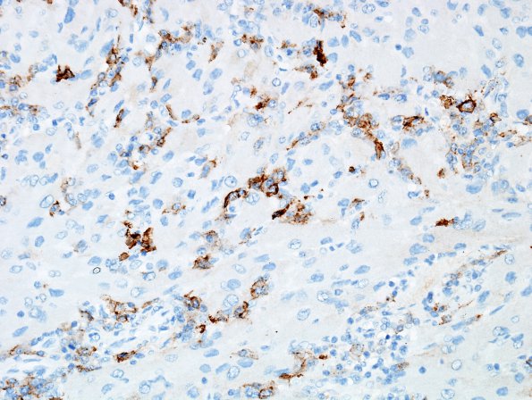 1I4 Granular Cell Tumor (Case 1) EMA 2.