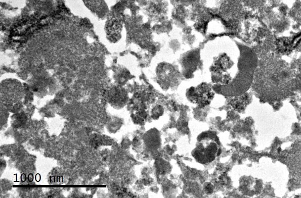 1J8 Granular Cell Tumor (Case 1) EM 6 - Copy