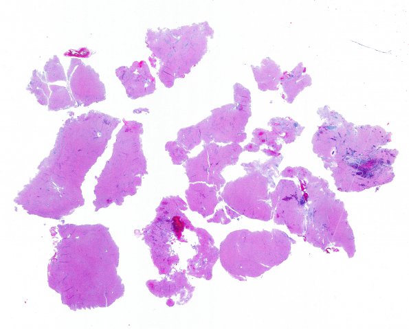 2A1 Granular Cell Tumor, Sella Region (Case 2) H&E WM