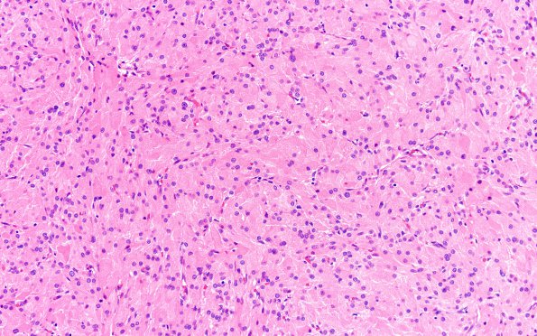 2A2 Granular Cell Tumor, Sella Region (Case 2) H&E 10X