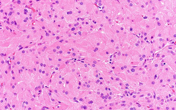 2A3 Granular Cell Tumor, Sella Region (Case 2) H&E 20X 3