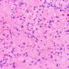 2A4 Granular Cell Tumor, Sella Region (Case 2) H&E 40X 1