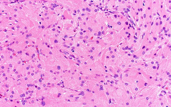 2A4 Granular Cell Tumor, Sella Region (Case 2) H&E 40X 1