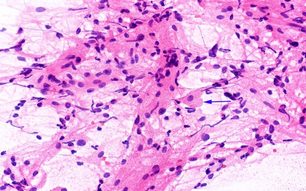 2A5 Granular Cell Tumor, Sella Region (Case 2) H&E Smear 40X copy