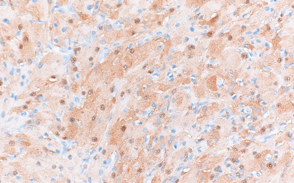 2B3 Granular Cell Tumor, Sella Region (Case 2) S100 40X 4