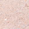 2C2 Granular Cell Tumor, Sella Region (Case 2) CD68 20X 1