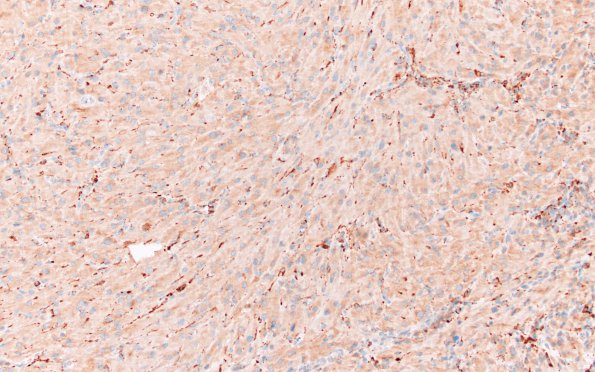 2C2 Granular Cell Tumor, Sella Region (Case 2) CD68 20X 1