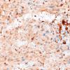 2C4 Granular Cell Tumor, Sella Region (Case 2) CD68 40X 2