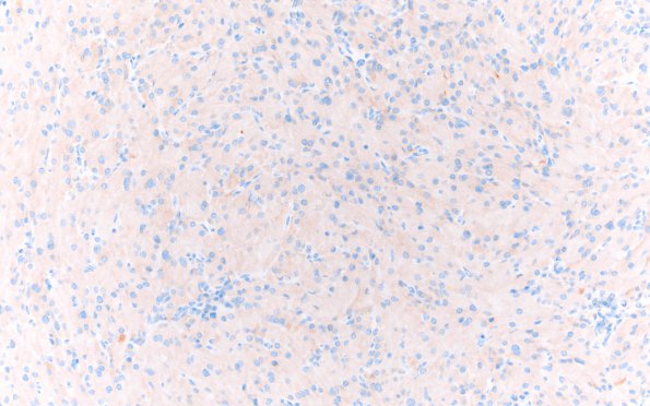 2D2 Granular Cell Tumor, Sella Region (Case 2) SYN 20X A