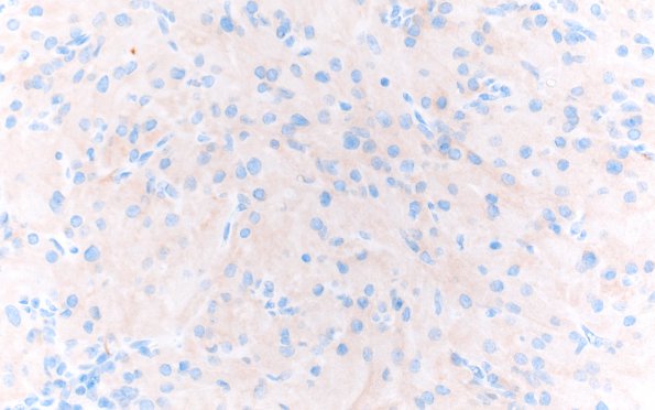 2D3 Granular Cell Tumor, Sella Region (Case 2) SYN 40X