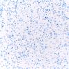 2D4 Granular Cell Tumor, Sella Region (Case 2) CHR 20X A