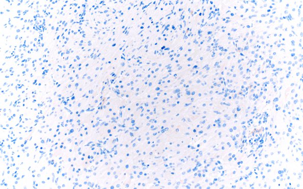 2D4 Granular Cell Tumor, Sella Region (Case 2) CHR 20X A