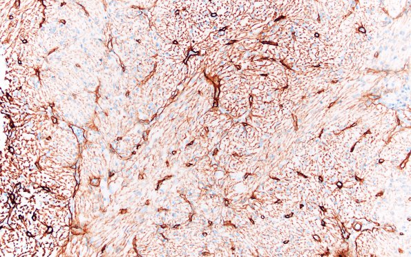 2F2 Granular Cell Tumor, Sella Region (Case 2) Coll IV 20X