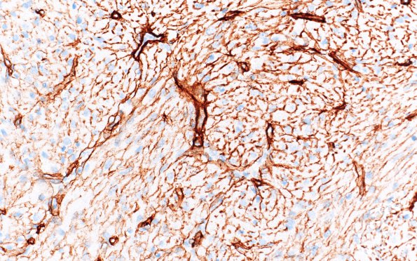 2F3 Granular Cell Tumor, Sella Region (Case 2) Coll IV 40X