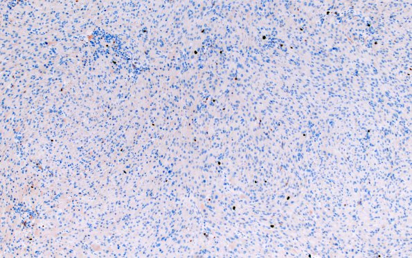 2G1 Granular Cell Tumor, Sella Region (Case 2) Ki67 10X