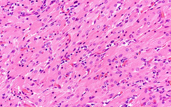 3A2 Granular cell tumor, infundibulum (Case 3) H&E 3