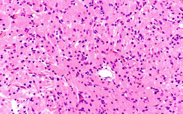 3A3 Granular cell tumor, infundibulum (Case 3) H&E 6