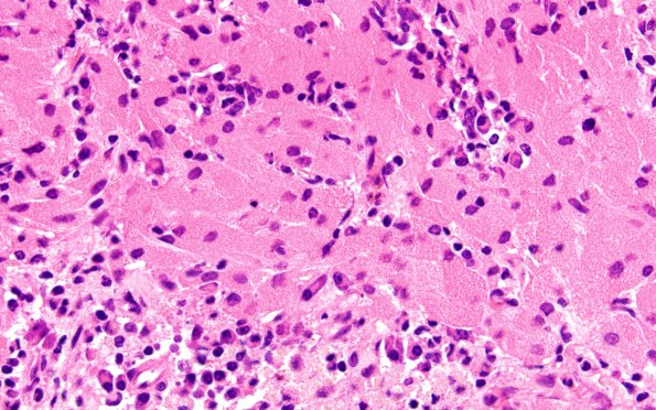 3A4 Granular cell tumor, infundibulum (Case 3) H&E 10